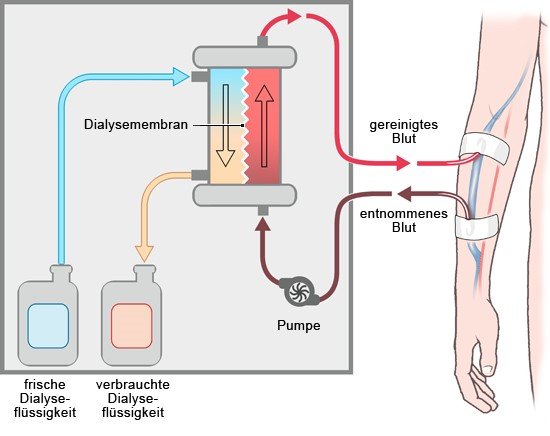 Wie Funktioniert Eine Dialyse Gesundheitsinformation De