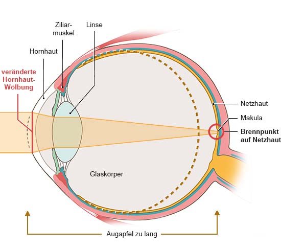 Grafik: Anatomische Darstellung eines Auges in Seitenansicht Die Hornhaut ist abgeflacht, Licht trifft gebündelt auf die Netzhaut.