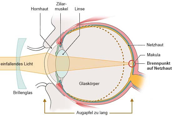 Grafik: Anatomische Darstellung eines Auges plus Brillenglas in Seitenansicht. Licht trifft gebündelt auf die Netzhaut.