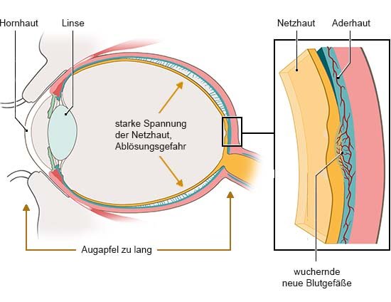 Grafik: Anatomische Darstellung eines Auges in Seitenansicht. Die Netzhaut ist leicht vom Auge gelöst.