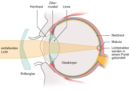 Grafik: Anatomische Darstellung eines Auges plus Brillenglas in Seitenansicht. Licht trifft gebündelt auf die Netzhaut.