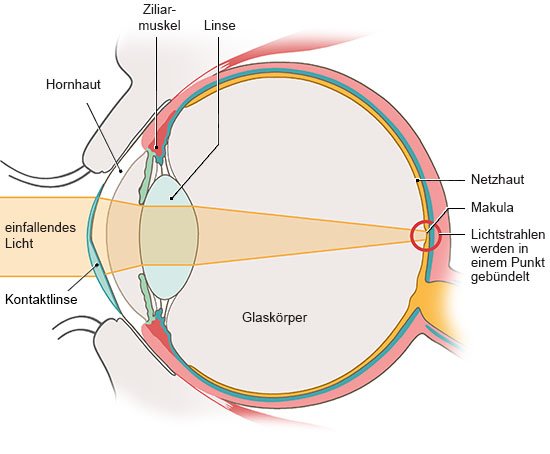 Grafik: Anatomische Darstellung eines Auges plus Kontaktlinse in Seitenansicht. Licht trifft gebündelt auf die Netzhaut.