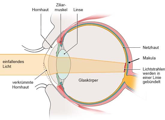 Grafik: Anatomische Darstellung eines Auges mit verkrümmter Hornhaut in Seitenansicht. Licht trifft nicht gebündelt auf die Netzhaut.