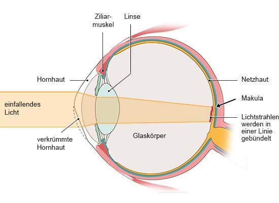 Grafik: Anatomische Darstellung eines Auges mit verkrümmter Hornhaut in Seitenansicht, Licht trifft nicht gebündelt auf die Netzhaut.