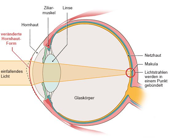 Grafik: Anatomische Darstellung eines Auges mit korrigierter Hornhaut in Seitenansicht. Licht trifft gebündelt auf die Netzhaut.