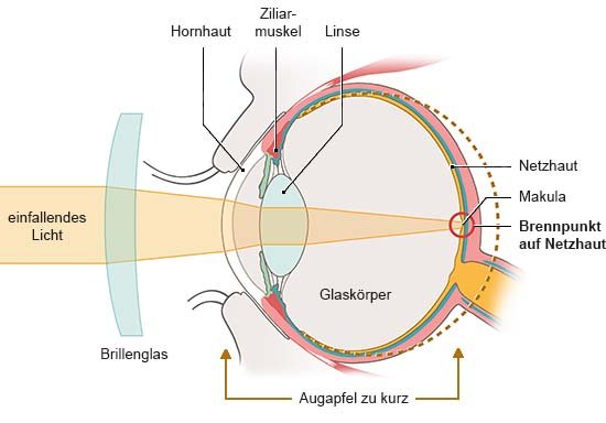 Grafik: Anatomische Darstellung eines Auges plus Brillenglas in Seitenansicht. Licht trifft gebündelt auf die Netzhaut.