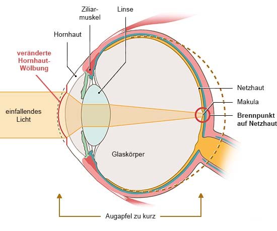 Grafik: Anatomische Darstellung eines Auges in Seitenansicht. Die Hornhaut ist stärker gewölbt, Licht trifft gebündelt auf die Netzhaut.