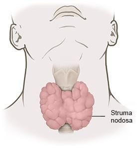 Grafik: Knotige Vergrößerung der Schilddrüse (Struma nodosa)