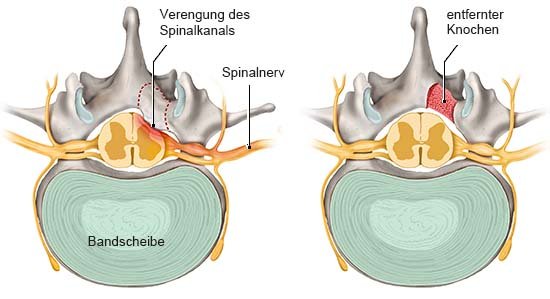 Die anatomische Grafik zeigt die Dekompression eines Wirbels. Links ist der Ausgangszustand mit einer Verengung des Spinalkanals zu sehen, die Druck auf den Spinalnerv ausübt. Rechts ist derselbe Wirbel nach erfolgter Dekompression zu sehen, bei der ein Knochenstück entfernt wurde, um Druck von den Nerven zu nehmen. 