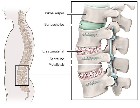 Die anatomische Grafik zeigt das Vorgehen bei einer Wirbelkörperversteifung mit Detailansicht von Wirbelkörper, Bandscheibe, Ersatzmaterial sowie Schrauben und Metallstab.